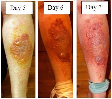 giant hogweed burn